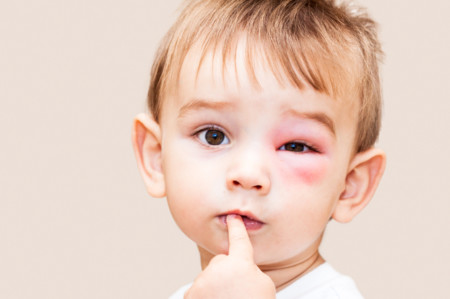 NiÃ±o con reacciÃ³n alÃ©rgica